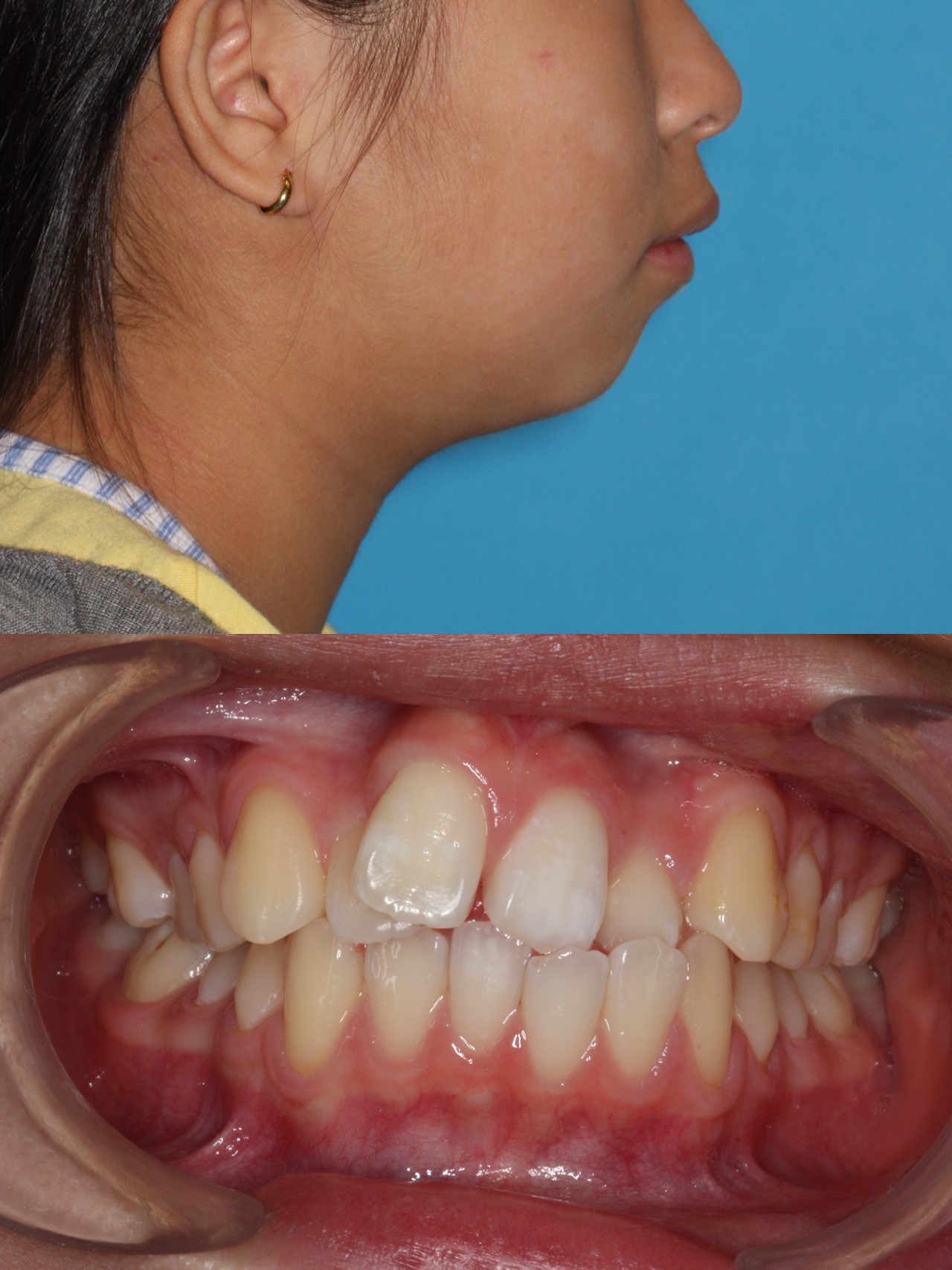 Lithgow_Orthodontics_Braces_Slide11 Lithgow Ortho
